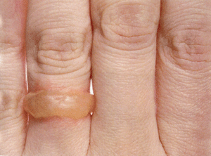 Blister Ring by Tiffany Parbs